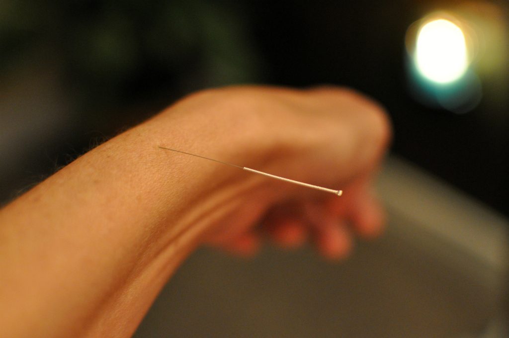 Acupuncture Needle