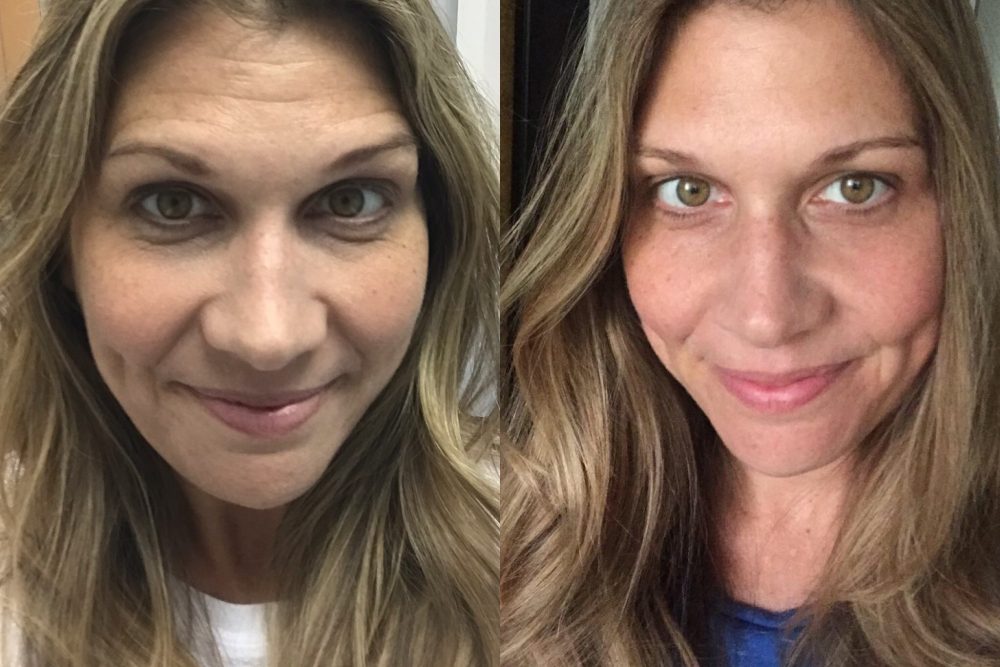 Not sure if you are ready for Botox? Read why this wife went for it and loved every second of it!
