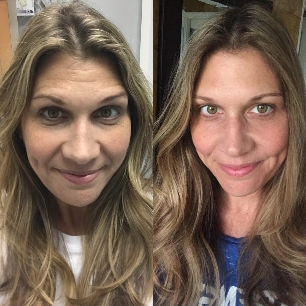 Not sure if you are ready for Botox? Read why this wife went for it and loved every second of it!